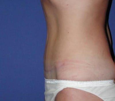 After Image: Abdominoplasty 3 Months Post-Op - other