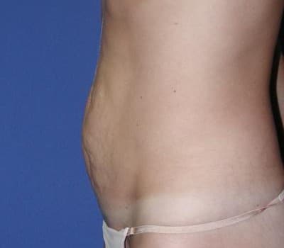 Before Image: Abdominoplasty 3 Months Post-Op - other