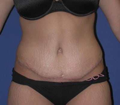 After Image: 21 Years Old  Abdominoplasty - front