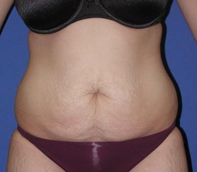 Before Image: 21 Years Old  Abdominoplasty - front