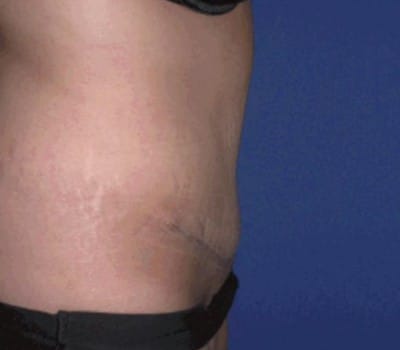 After Image: 21 Years Old  Abdominoplasty - other