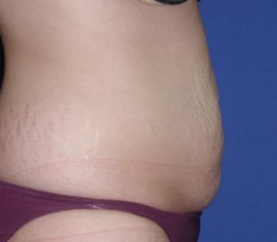 Before Image: 21 Years Old  Abdominoplasty - other