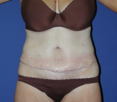 After Image: Simultaneous Abdominoplasty Flank Lipo - front