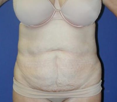 Before Image: Simultaneous Abdominoplasty Flank Lipo - front