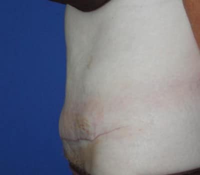 After Image: Simultaneous Abdominoplasty Flank Lipo - other