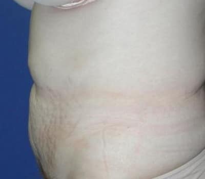 Before Image: Simultaneous Abdominoplasty Flank Lipo - other