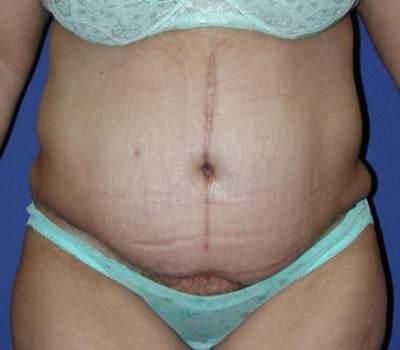 After Image: 2 Months Post-Op Abdominoplasty - front