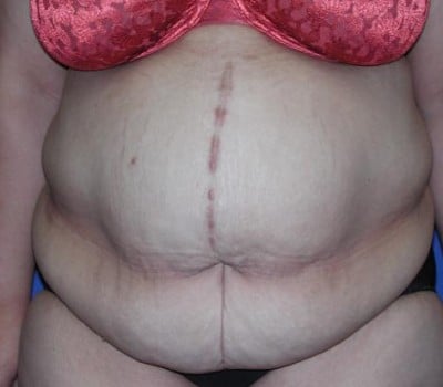 Before Image: 2 Months Post-Op Abdominoplasty - front
