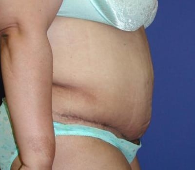 After Image: 2 Months Post-Op Abdominoplasty - other