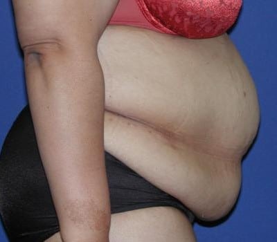 Before Image: 2 Months Post-Op Abdominoplasty - other