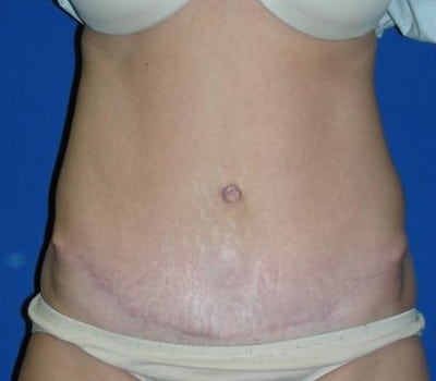 After Image: Skin Excision & Muscle Placation - front