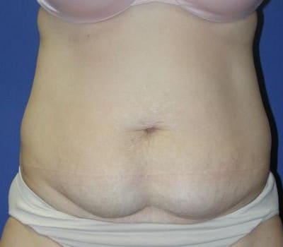 Before Image: Skin Excision & Muscle Placation - front