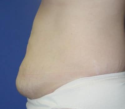 Before Image: Skin Excision & Muscle Placation - other