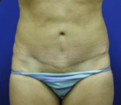 After Image: S/P Abdominoplasty - front
