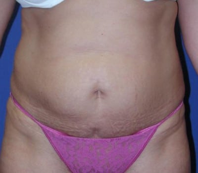 Before Image: S/P Abdominoplasty - front