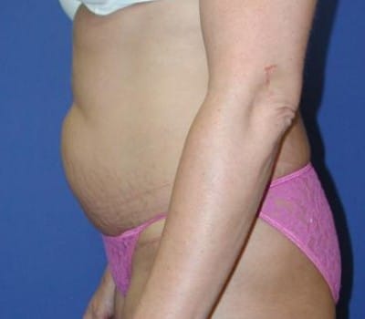 Before Image: S/P Abdominoplasty - right-side