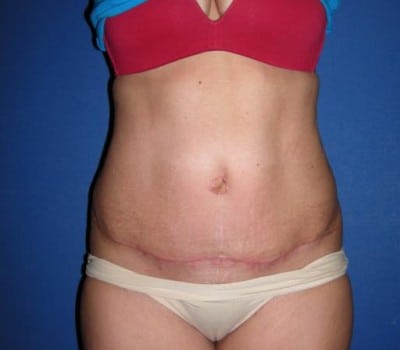 After Image: Abdominoplasty With Flank Lipo - front