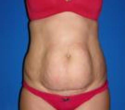 Before Image: Abdominoplasty With Flank Lipo - front