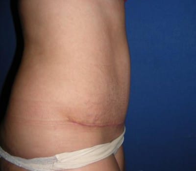After Image: Abdominoplasty With Flank Lipo - other