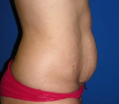 Before Image: Abdominoplasty With Flank Lipo - other
