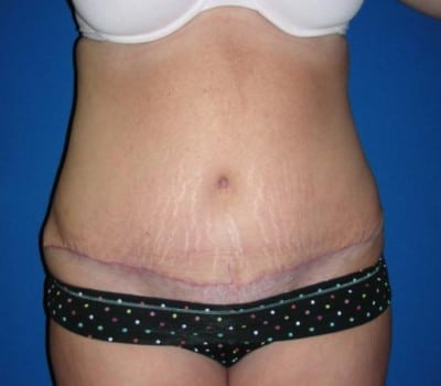 After Image: Abdominoplasty With Simultaneous Hysterectomy - front