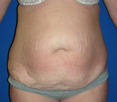 Before Image: Abdominoplasty With Simultaneous Hysterectomy - front