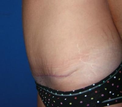 After Image: Abdominoplasty With Simultaneous Hysterectomy - other