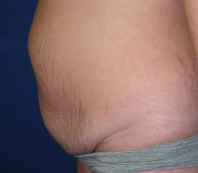 Before Image: Abdominoplasty With Simultaneous Hysterectomy - other