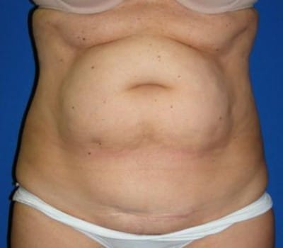 Before Image: Abdominoplasty & Flank Lipo With Simultaneous OB-Gyn Procedure - front