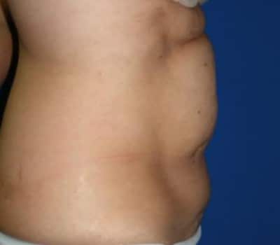 Before Image: Abdominoplasty & Flank Lipo With Simultaneous OB-Gyn Procedure - other