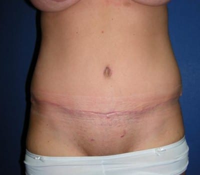 After Image: Traditional Abdominoplasty - front
