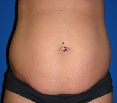 Before Image: Traditional Abdominoplasty - front