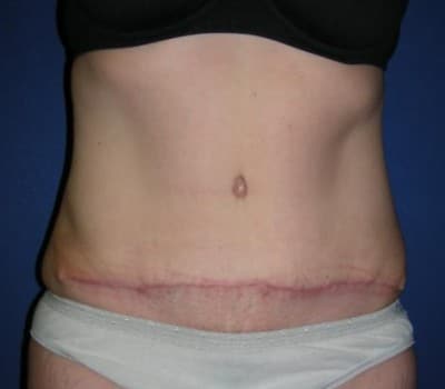 After Image: 6 Weeks Post-Op Traditional Abdominoplasty - front