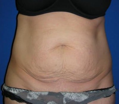 Before Image: 6 Weeks Post-Op Traditional Abdominoplasty - front