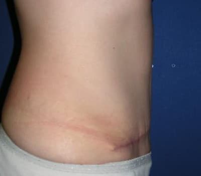 After Image: 6 Weeks Post-Op Traditional Abdominoplasty - other