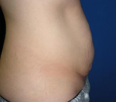 Before Image: 6 Weeks Post-Op Traditional Abdominoplasty - other