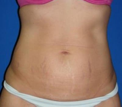 Before Image: 3 Children & Lost 20 lbs - front