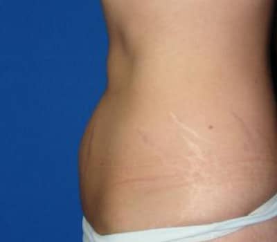 Before Image: 3 Children & Lost 20 lbs - other