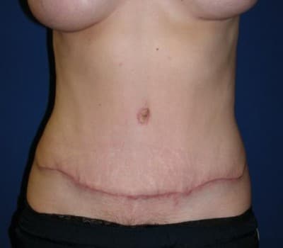 After Image: 5 Pregnancies - front