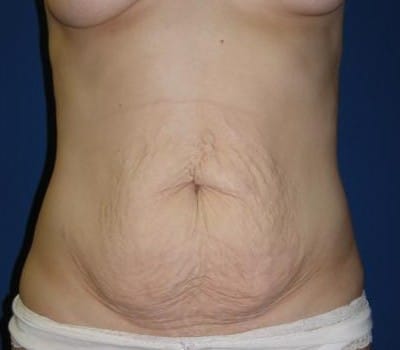 Before Image: 5 Pregnancies - front