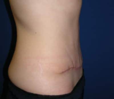 After Image: 5 Pregnancies - other