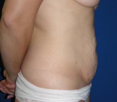 Before Image: 5 Pregnancies - other