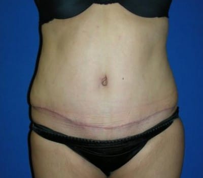 After Image: Abdominoplasty & Flank Lipo - front