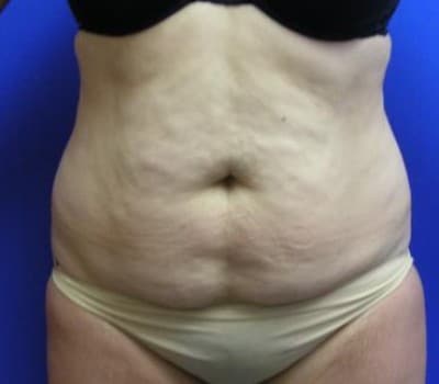 Before Image: Abdominoplasty & Flank Lipo - front