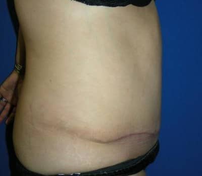 After Image: Abdominoplasty & Flank Lipo - other