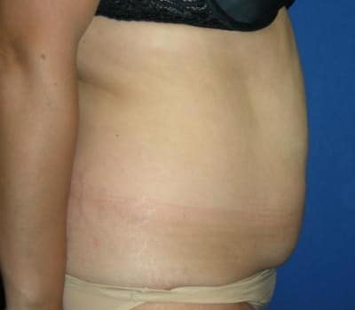 Before Image: Abdominoplasty & Flank Lipo - other