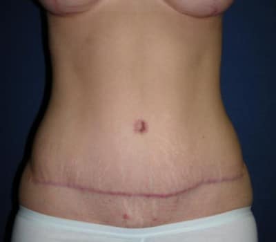 After Image: 31 Years Old Abdominoplasty - front