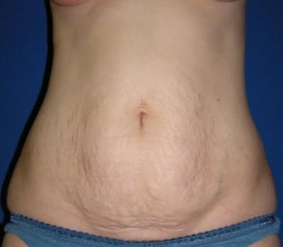 Before Image: 31 Years Old Abdominoplasty - front