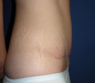 After Image: 31 Years Old Abdominoplasty - other