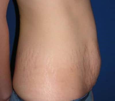 Before Image: 31 Years Old Abdominoplasty - other